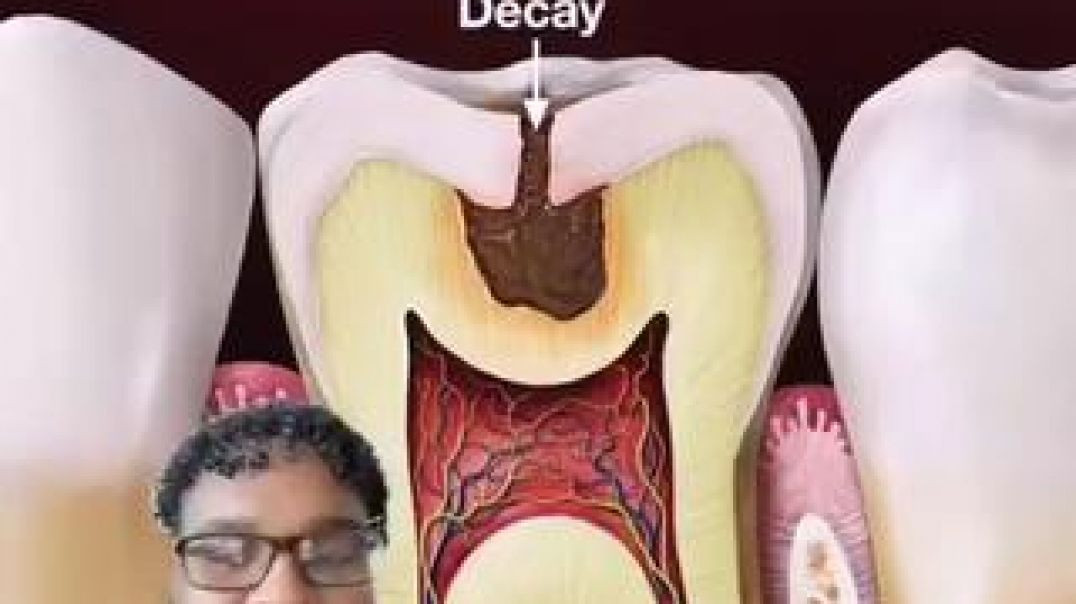 IT'S TIME TO REVERSE YOU TOOTH DECAY NATURALLY! LISTEN TO THIS! ☤ DR KEK