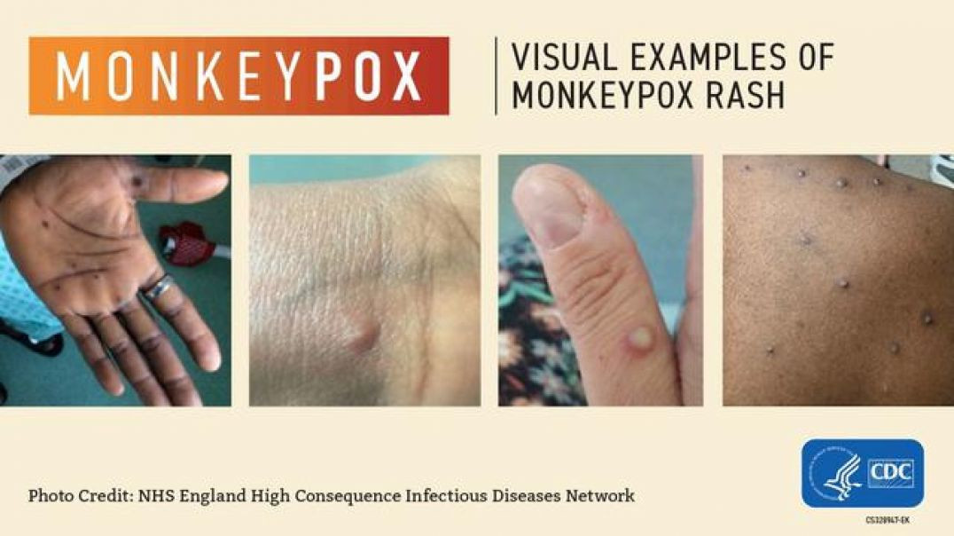 ⁣DR DAVID MARTIN ON HOW MONKEYPOX 🙈🙉🙊💉 IS JUST A COVER-UP FOR COVID JAB ADVERSE EFFECTS