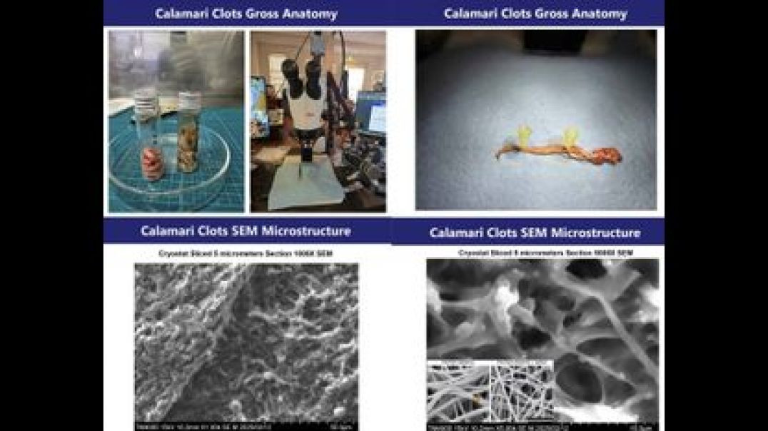 ⁣WHITE CLOT UPDATE ⚕ JOHN OLOONEY