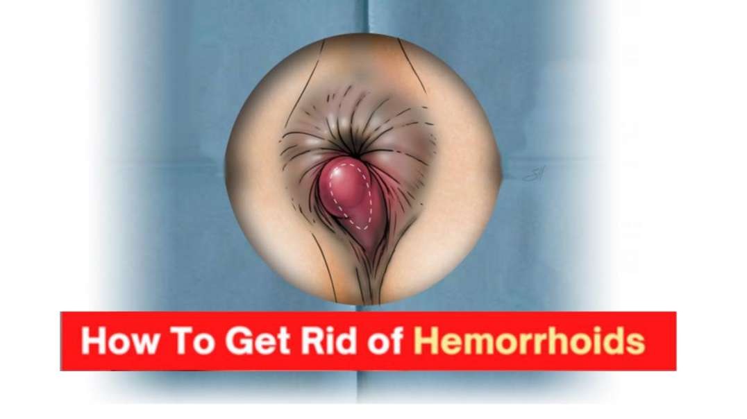 How To Permanently Treat Your Hemorrhoids In 48 Hours