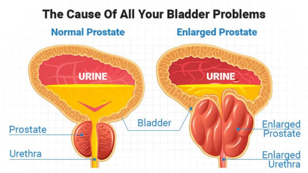 The Cause Of All Your Bladder Problems - Enlarged Prostate