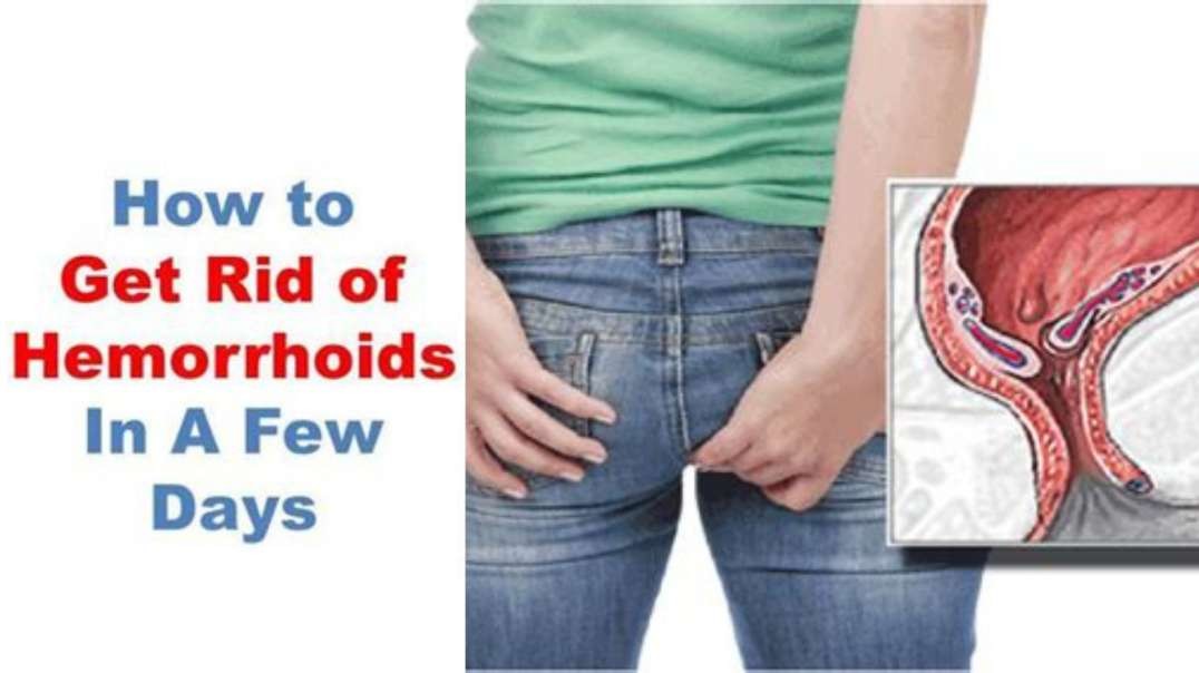 shrink external hemorrhoids in 48 hours