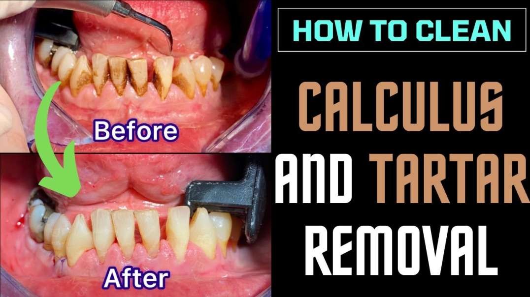 How To Clean Calculus , Tartar And Plaque Removal Without Going To The Dentist