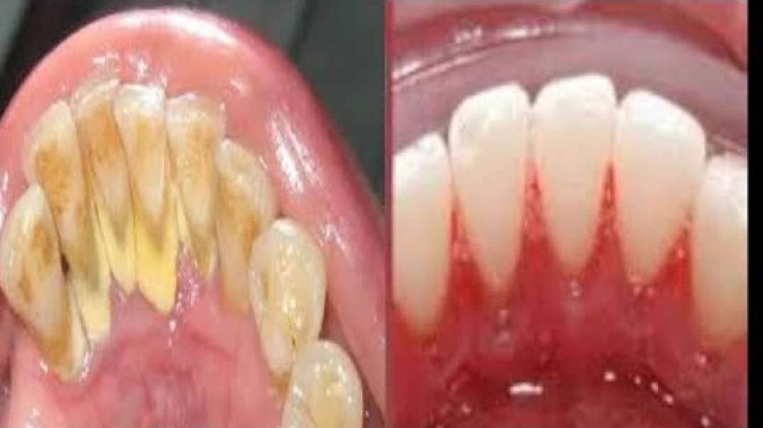This Is Why You Should Not visit The Dentist 5 Minutes Plaque Removal
