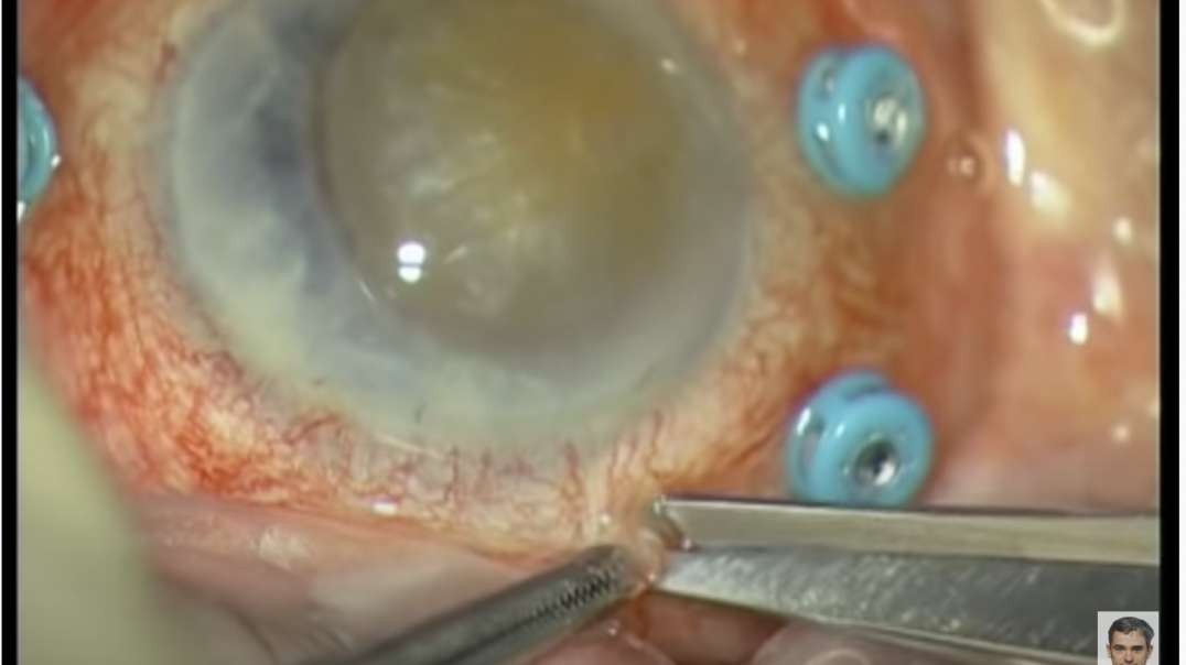 THIS Breakthrough Discovery Left Ophthalmologists Stunned! - A Perfect 20-20 Vision After JUST 3 Wee