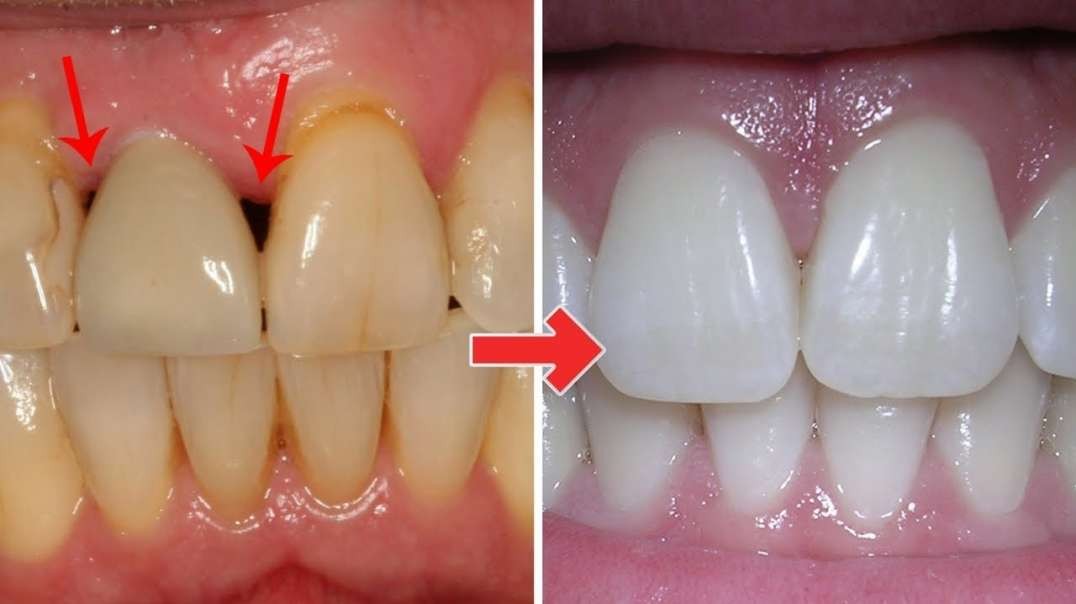 Ridiculously Easy Eays to Treat Gum Disease at Home