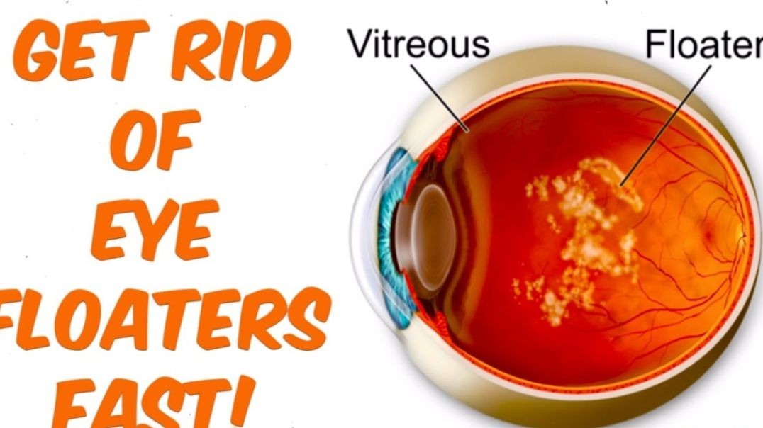 How To Cure Eye Floaters Naturally Without Surgery