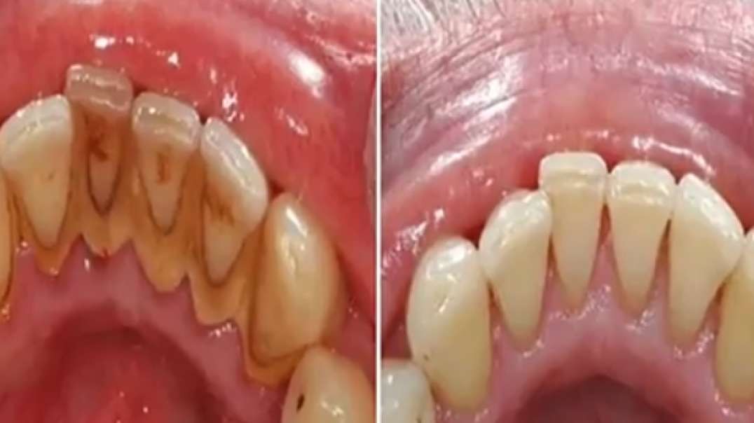 How to remove “PLAQUE” without going to the “DENTIST” Awesome!