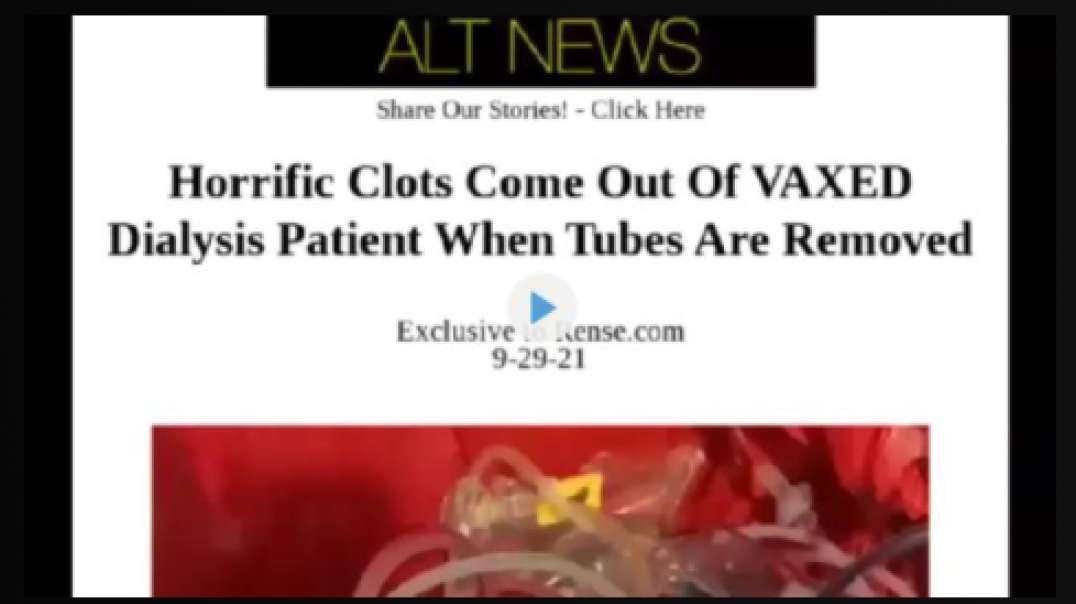 Horrific Blood Clots Come Out of VAXXED Dialysis Patient When Tubes Are Removed!!!