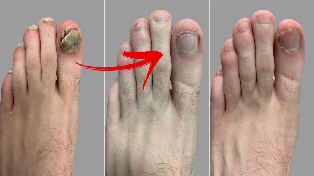 Steps To Get Rid of Toenail Fungus Naturally Once and For All