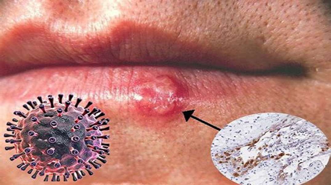 Eliminate the Herpes Virus from Your Body Within A Short Period of Time