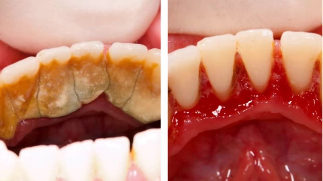 Remove TARTAR and Plaque Fast Without Going To Dentist, Natural WHITE TEETH