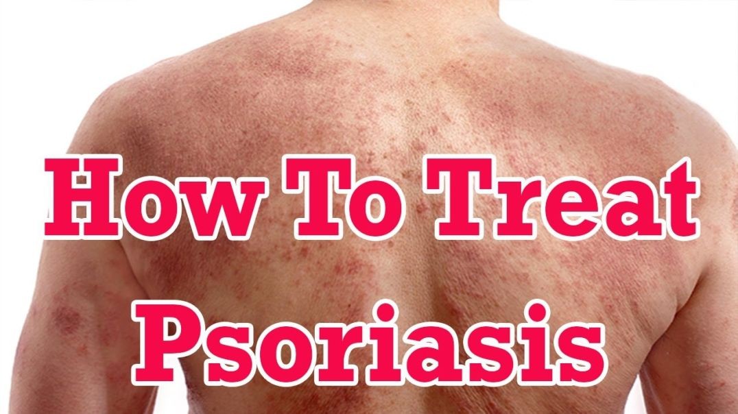 How To Get Rid of Psoriasis Naturally - Home Remedies For Psoriasis