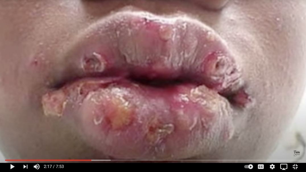 Discover This Unique Way To Destroy Herpes That Big Pharma Has Been Hiding From Us
