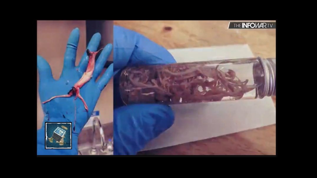 Mortician shows tentacle like fibrous blockages that were growing in people previously vaxxed