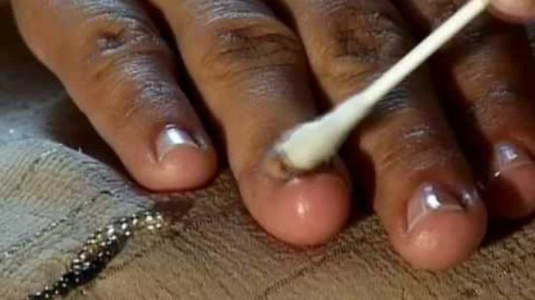 How to Cure Nail Fungus