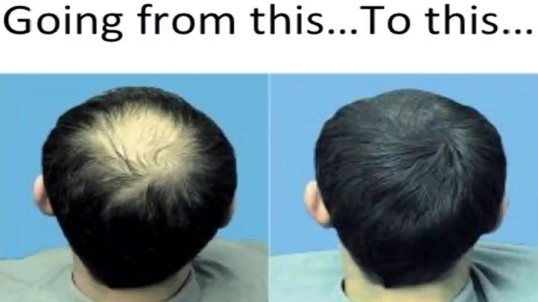 Balding Caused by Clogged Follicles That You Can Easily Clear With This 10-second Monk Ritual