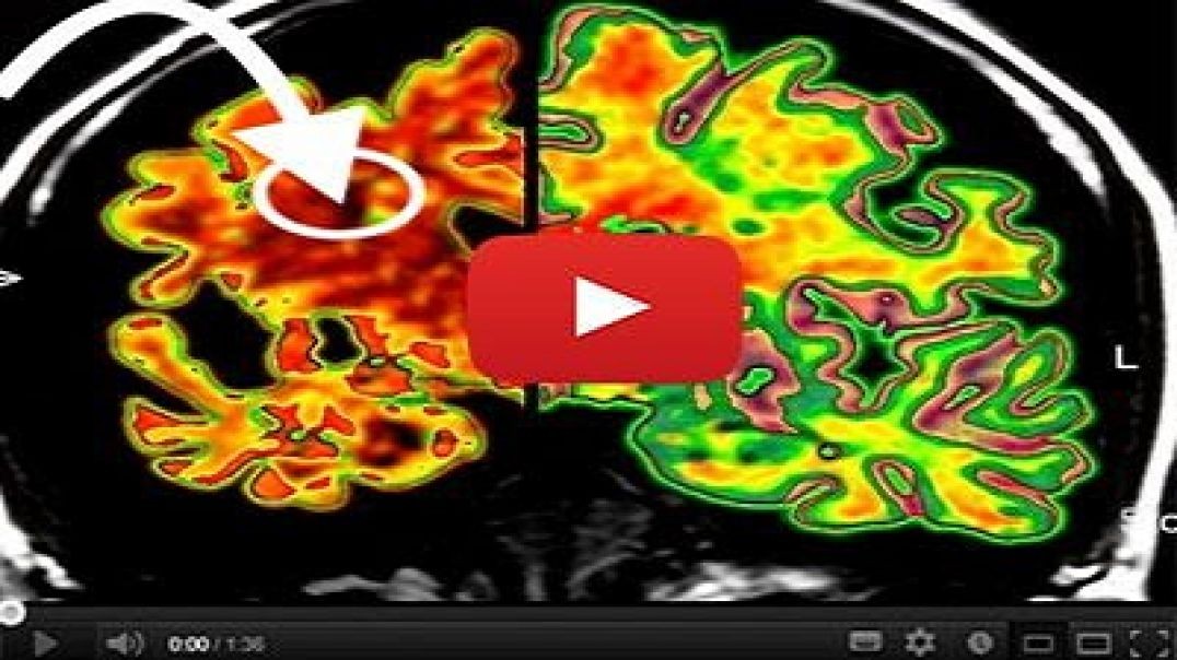 Brain Scan Clearly Shows Vertigo Has Very Little To Do With Your Age or Balance System