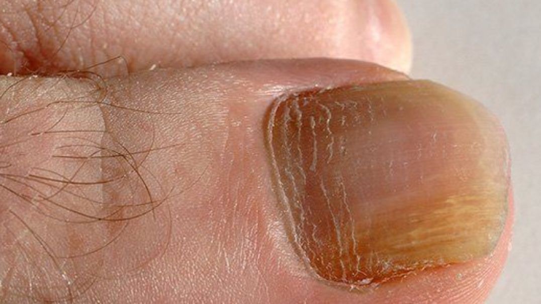 ⁣⁣How To Prevent Nail Fungus (And Treat It If It's Already Present)