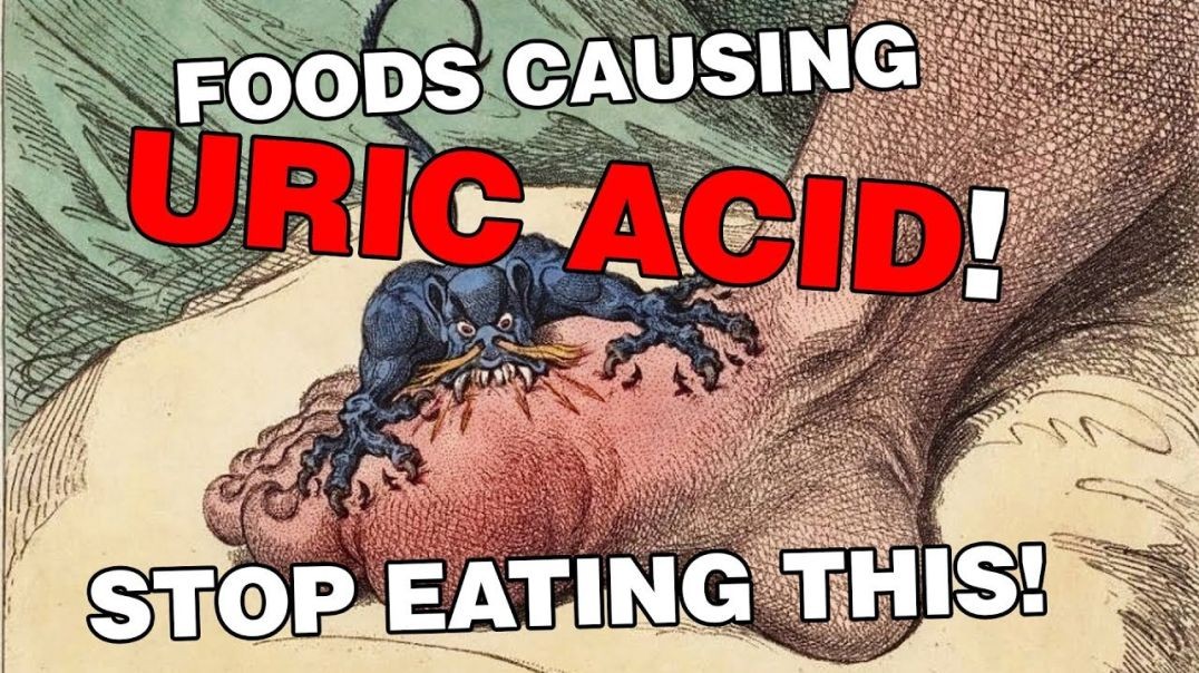 Stop Eating This, 10 Uric Acid (Gout) Causing Foods! (Hyperuricemia)
