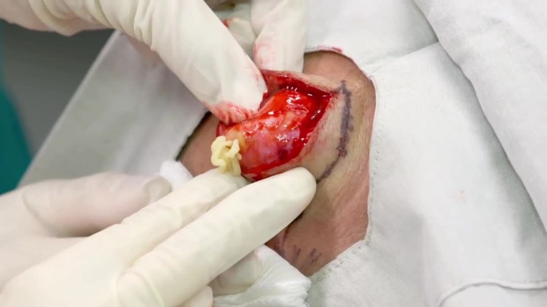 ⁣Dr. Lee Squeezes An 18 Year Old Cyst! Dr. Pimple Popper