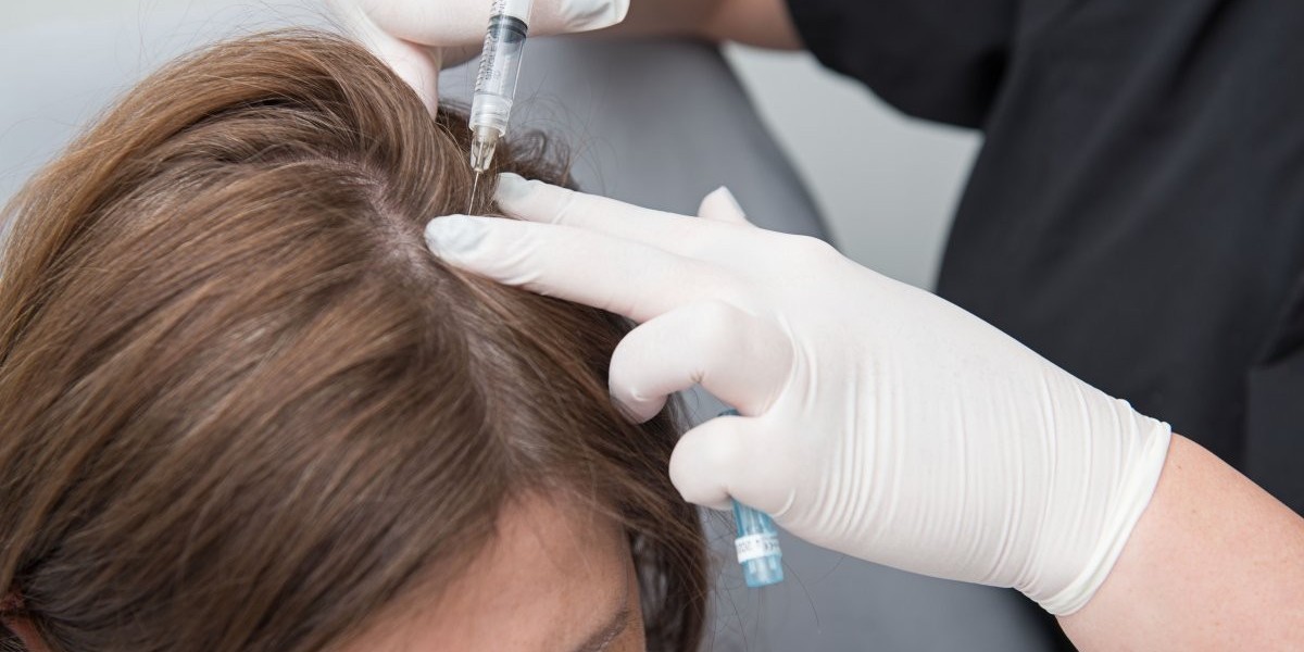 PRP Beverly Hills: The Ultimate Solution for Hair Restoration